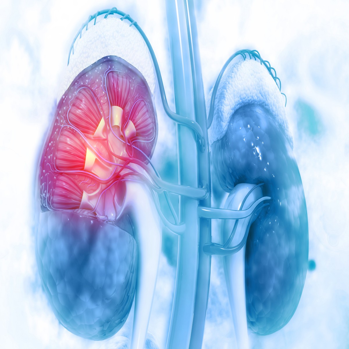 A Case of Chronic Kidney Disease, secondary to DM