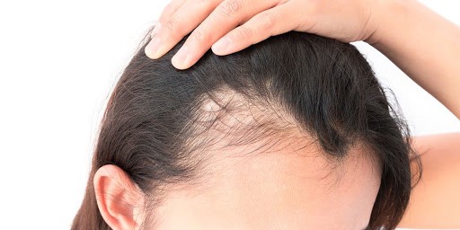 Androgenic Alopecia - AGA